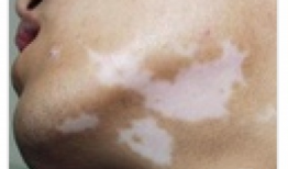 白癜风可以吃小白瓜吗,营养与健康的双重选择